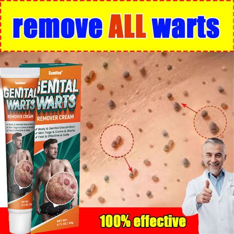 Wart Removal Ointment For Privates 20g Men Private Parts Wart Remover Male Genital Warts Removal