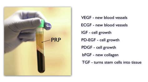 Benefits Of Prp Injection Under Eyes Dr Prasad New York