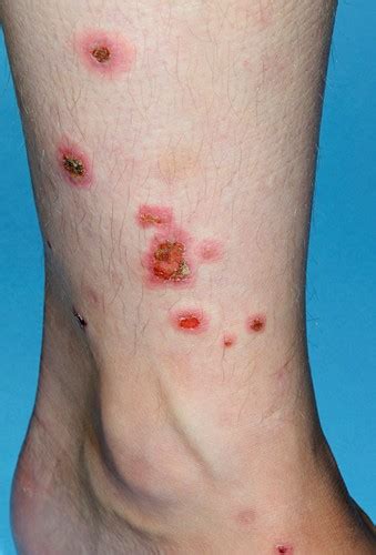 Erythema Multiforme Bilder Science Photo Library