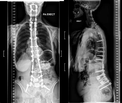 Posteroanterior And Lateral Erect Radiographs Demonstrating Surgical