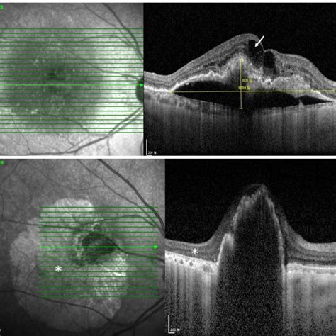 Retinal Pigment Epithelium Rpe Tear Case A Pigment Epithelial