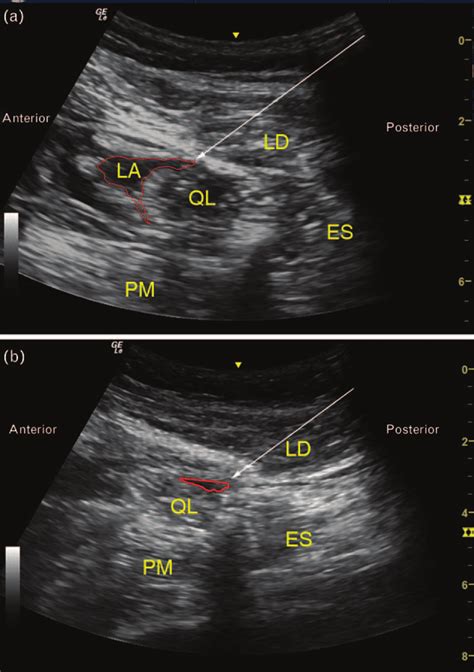 Sonography Of Lateral Quadratus Lumborum Block A And Posterior Download Scientific Diagram