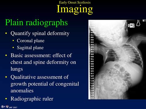 Imaging In Early Onset Scoliosis Ppt Download