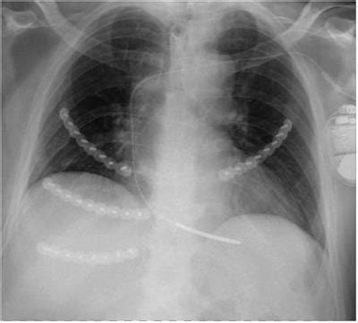 Frontiers Outcomes After Fixation Of Rib Fractures Sustained During