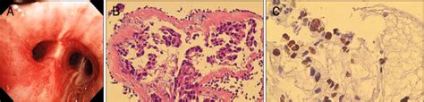 Bronchoscopic findings and bronchial biopsy specimen. (A) Bronchoscopy ...