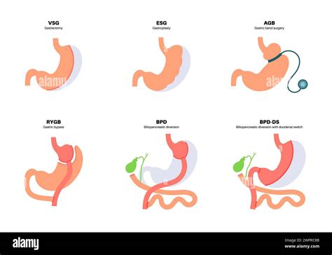 Types of bariatric surgery, illustration Stock Photo - Alamy