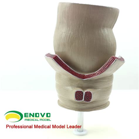 Enovo Viscera Pathological Model Of The Rectum Xlife Size Human