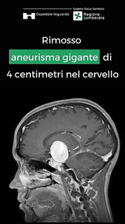 Aneurisma Gigante Rimosso Dal Cervello Di Una Enne Con Tecnica D