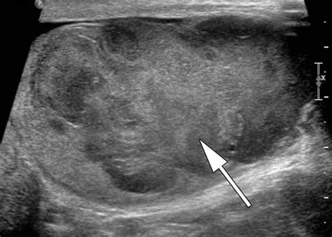 Testicular Seminoma And Its Mimics From The Radiologic Pathology