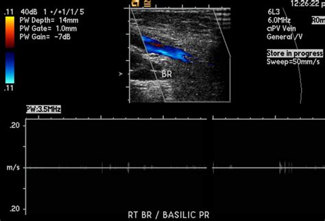 Deep vein thrombosis ultrasound - wikidoc