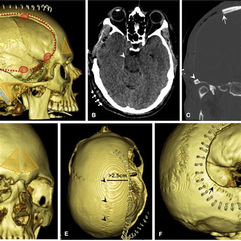 A 3D CT Scan Major Bone Landmarks For Decompressive Craniectomy B