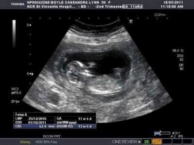 12 Weeks Pregnant Ultrasound: What to Expect? | IYTmed.com