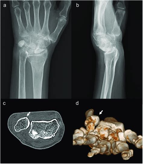 A And B Posteroanterior And Lateral View Radiographs Of The Left Wrist