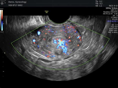 Ecografia Pelvica Transvaginale Roma Eur