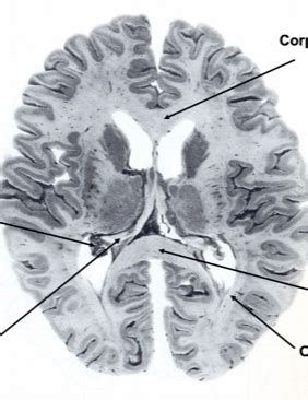 Neuro Flashcards Quizlet