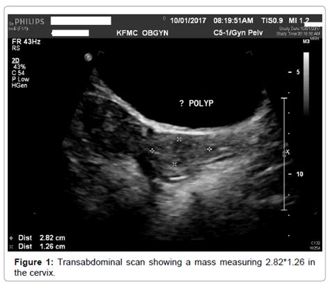 Cervical Polyps Ultrasound