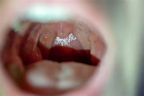 ᐈ Tonsils stock images Royalty Free tonsils photos download on