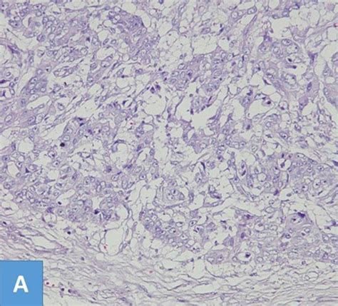 Invasive Ductal Carcinoma Histology