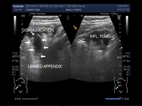 Perforated Appendix Ultrasound