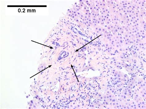 Primary Sclerosing Cholangitis Libre Pathology