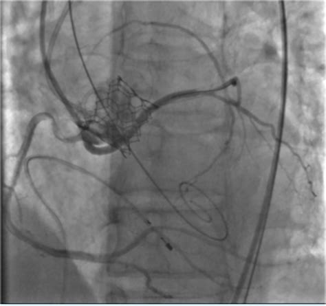 Tctap C A Challenging Case Of Tavr With Coronary Protection In A