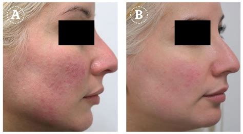 The Uses Of Long Pulsed Nd Yag Laser In Dermatology Prime Journal