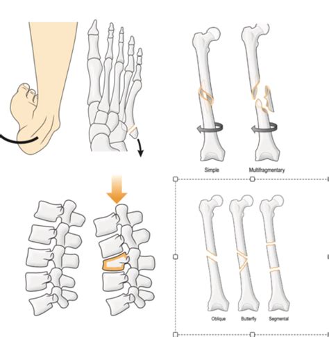 Fractures Flashcards Quizlet