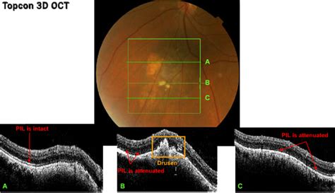 Suspicious Nevus – page 6 of 23 - Retina Revealed