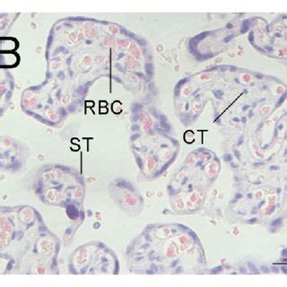 Pathological Morphology Of Placentas From Control Group A B And Gdm