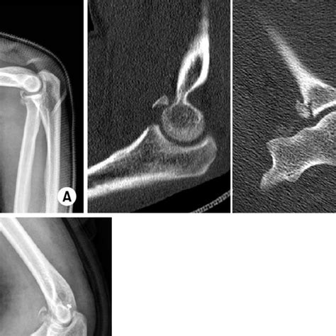 A Preoperative Antero Posterior And Lateral Radiographs B Regan Download Scientific