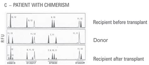 Examples Of Chimerism Analysis Results Using STR Analysis DNA Was