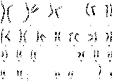 A Karyotype Of 47xyþmar In The Fetus The Arrow Indicates The Marker