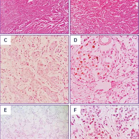 Immunohistochemical Staining Of Breast Carcinoma For Estrogen Receptor