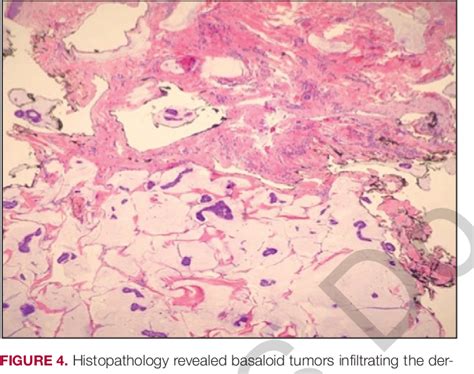 Figure 4 From Endocrine Mucin Producing Sweat Gland Carcinoma And