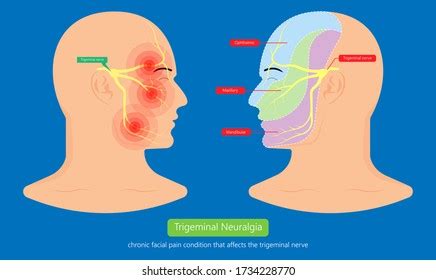 Trigeminal Neuralgia Causes In Hindi Mapasgmaes