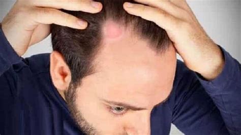 Sa K Ran Alopesi Areata Nedir Neden Olur Sa K Ran Belirtileri