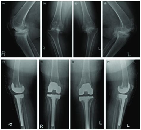 Case Presentation For Use Of Modular Augments A D Preoperative And