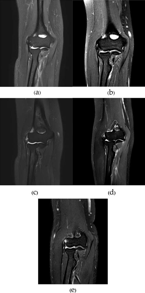 MRI illustration for the degree of common extensor tendon injuries. The... | Download Scientific ...