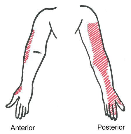 Radial Nerve Block - Pain Management