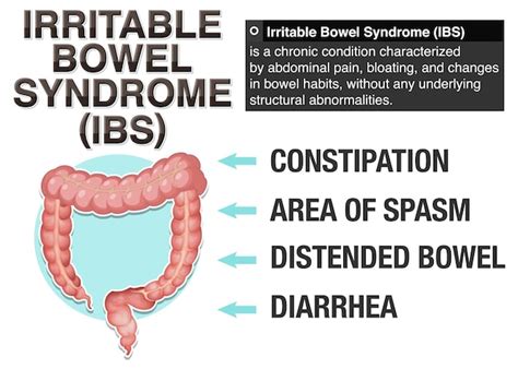 S Ndrome Del Intestino Irritable Ibs Infograf A Vector Premium