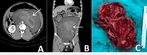 Retroperitoneal Bleed Ultrasound