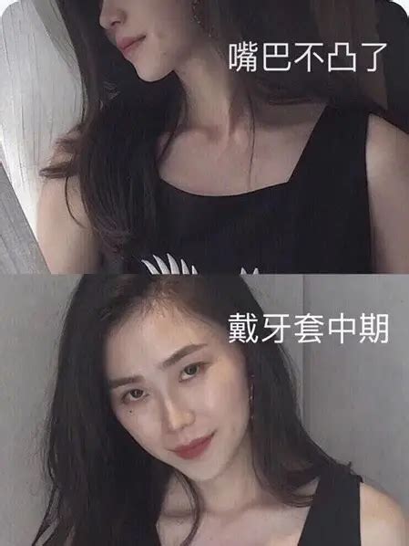 拔牙后的几个为什么？你有做到位吗？ 知乎