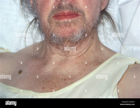 Hirsutism Female Fotografías E Imágenes De Alta Resolución Alamy