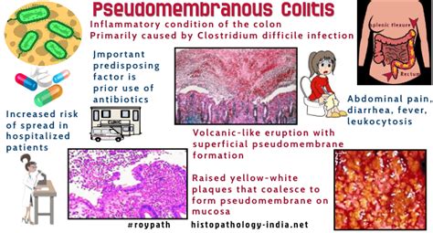 Pathology Of Pseudomembranous Colitis Antibiotic Associated Colitis Or Clostridium Difficile