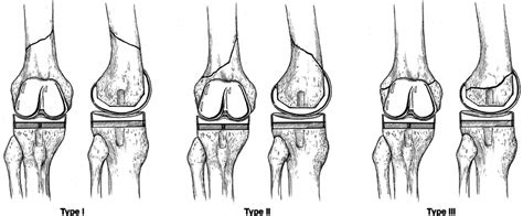 Anteroposterior And Lateral Views Of Supracondylar Periprosthetic Download Scientific Diagram