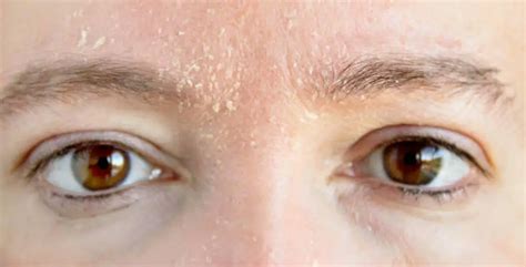 What are the risk factors towards developing eye brow dandruff - Treat ...