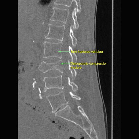 Osteoporotic Vertebral Fracture