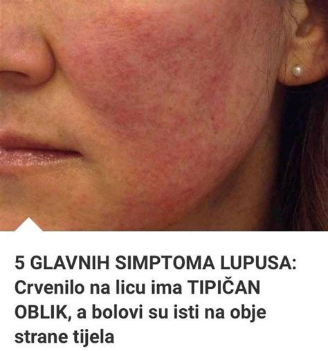 5 GLAVNIH SIMPTOMA LUPUSA Crvenilo na licu ima TIPIČAN OBLIK a bolovi