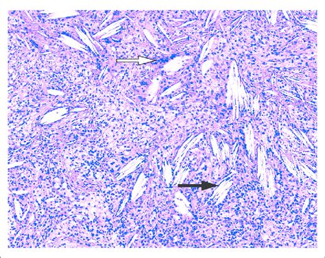 A Granulomatous Infiltrate Associated With Multinucleated Giant Cells