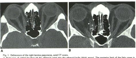 Figure 1 from Dehiscence of the lamina papyracea of the ethmoid bone ...